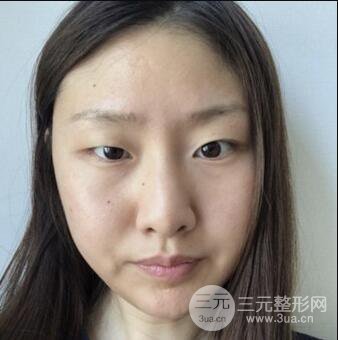 西安葉子魯禮新埋線雙眼皮案例對(duì)照?qǐng)D!兩個(gè)月恢復(fù)心情小記