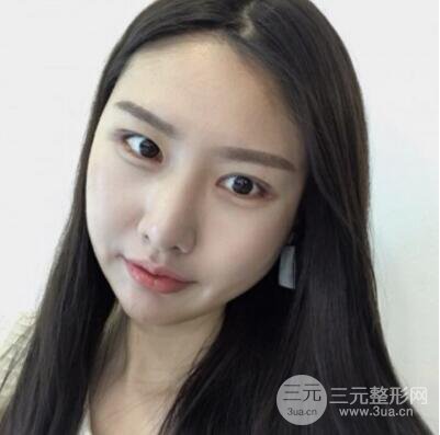 西安葉子魯禮新埋線雙眼皮案例對(duì)照?qǐng)D!兩個(gè)月恢復(fù)心情小記