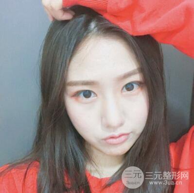 西安葉子魯禮新埋線雙眼皮案例對(duì)照?qǐng)D!兩個(gè)月恢復(fù)心情小記