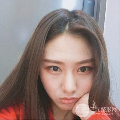 西安葉子魯禮新埋線雙眼皮案例對(duì)照?qǐng)D!兩個(gè)月恢復(fù)心情小記