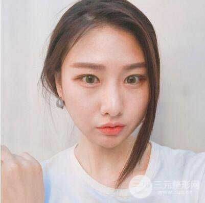 西安葉子魯禮新埋線雙眼皮案例對(duì)照?qǐng)D!兩個(gè)月恢復(fù)心情小記