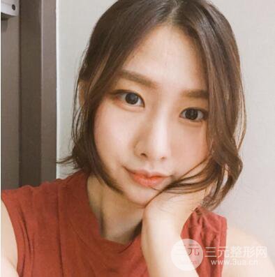 西安葉子魯禮新埋線雙眼皮案例對(duì)照?qǐng)D!兩個(gè)月恢復(fù)心情小記