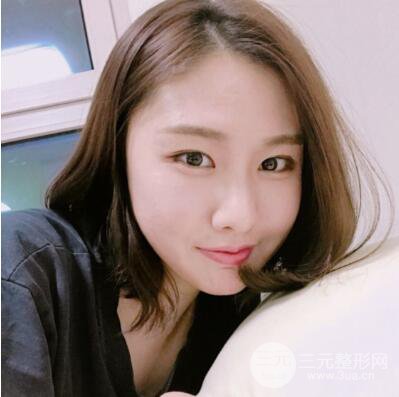 西安葉子魯禮新埋線雙眼皮案例對(duì)照?qǐng)D!兩個(gè)月恢復(fù)心情小記