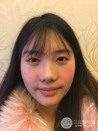 蘇州紫馨孫影塌鼻子假體隆鼻案例對(duì)比照心情小札