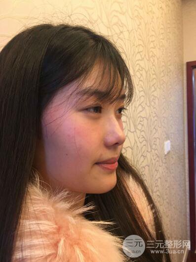 蘇州紫馨孫影塌鼻子假體隆鼻案例對(duì)比照心情小札