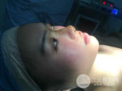 蘇州紫馨孫影塌鼻子假體隆鼻案例對(duì)比照心情小札