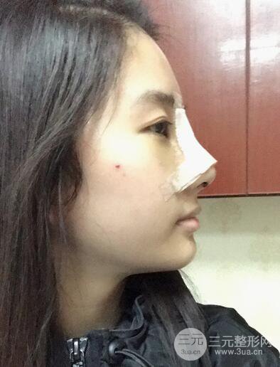 蘇州紫馨孫影塌鼻子假體隆鼻案例對(duì)比照心情小札