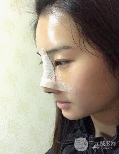 蘇州紫馨孫影塌鼻子假體隆鼻案例對(duì)比照心情小札