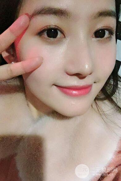 蘇州紫馨孫影塌鼻子假體隆鼻案例對(duì)比照心情小札