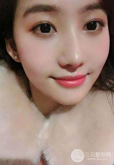 蘇州紫馨孫影塌鼻子假體隆鼻案例對(duì)比照心情小札