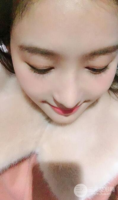 蘇州紫馨孫影塌鼻子假體隆鼻案例對(duì)比照心情小札