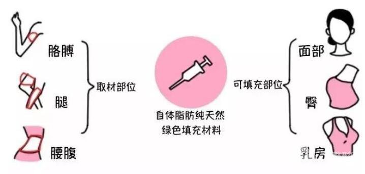 自體脂肪填充好嗎?果怎么樣?
