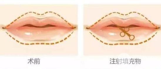 玻尿酸豐唇整形手術(shù)要多少錢？價格影響在于？