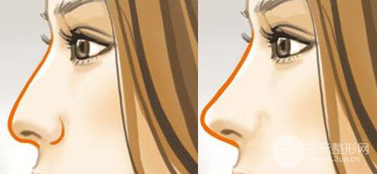 隆鼻手術(shù)恢復(fù)期有多久？恢復(fù)期護(hù)理要仔細(xì)