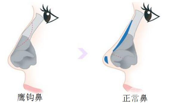 鷹鉤鼻矯正方法有什么？手術(shù)過程是怎樣的？