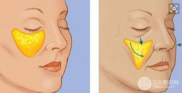 活體脂肪填充出現(xiàn)回縮情況需要補(bǔ)填嗎?