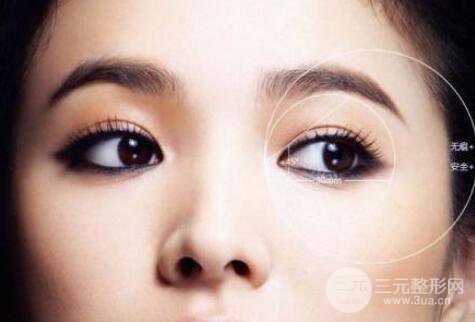 全切雙眼皮成好嗎?恢復(fù)期多久?