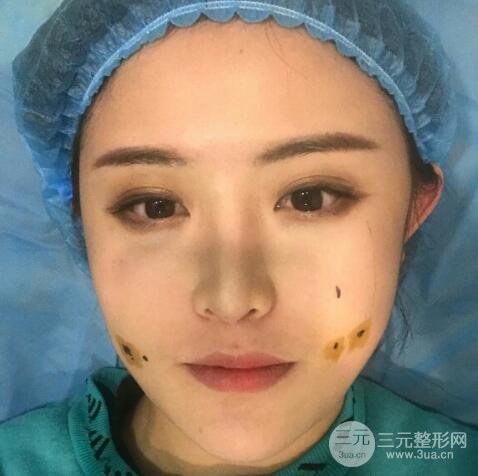 重慶華美酒窩整形價(jià)格