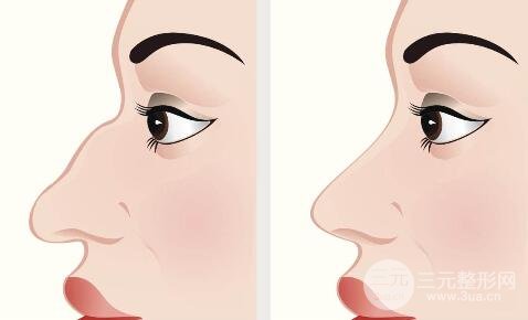 骨膜下隆鼻整形手術(shù)怎么做的？哪種情況適合做？