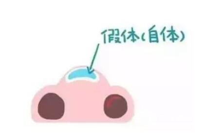 骨膜下隆鼻整形手術(shù)怎么做的？哪種情況適合做？