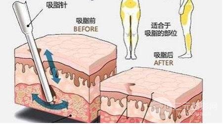 大腿吸脂減肥部位
