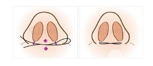 鼻翼兩側(cè)縮小