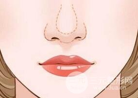 鼻翼兩側(cè)縮小會(huì)留疤痕嗎