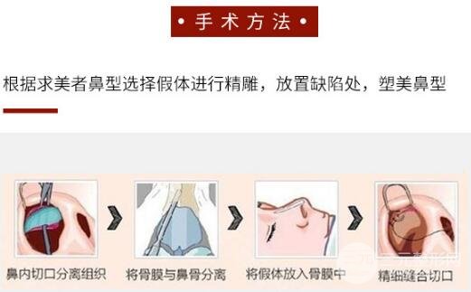 硅膠隆鼻要多少錢 手術(shù)怎么做