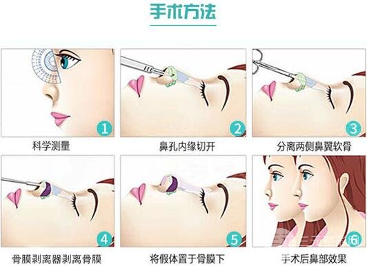 曼特波隆鼻降低風(fēng)險(xiǎn)嗎 手術(shù)原理