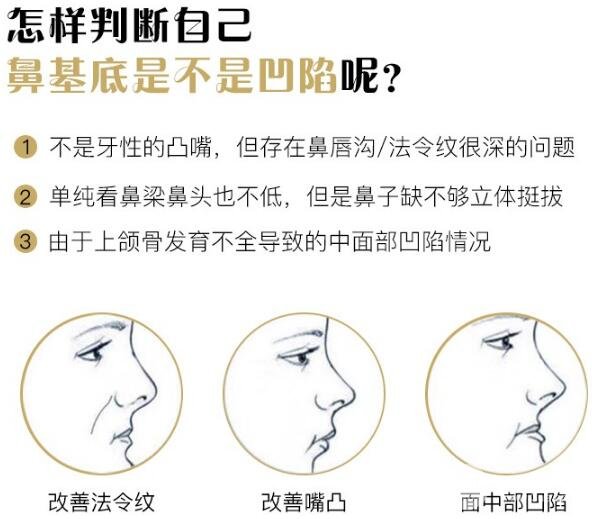 假體墊鼻基底多少錢？貴不貴