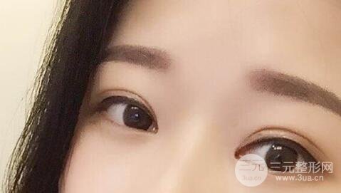 全割雙眼皮后的注意事項