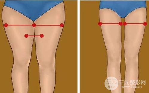 吸脂瘦大腿腫脹期是多久？多久能看到果？
