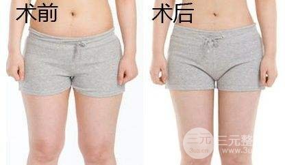 吸脂瘦大腿腫脹期是多久？多久能看到果？