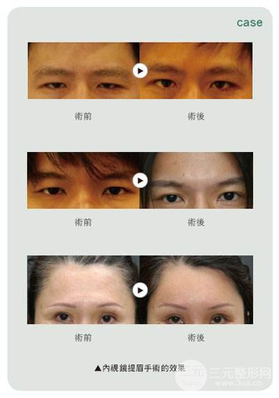 切眉術(shù)適合多大年齡做