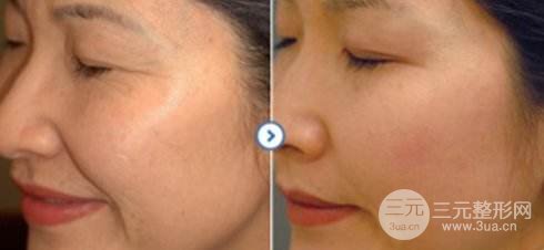 去皺多少錢 價格 方法 果圖