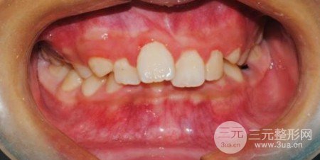 牙齒矯正必須拔牙嗎