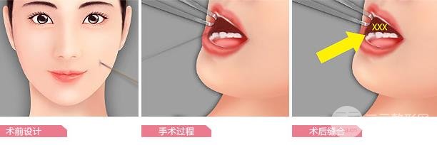 酒窩整形的方法