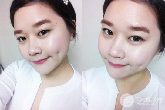 酒窩整形的方法