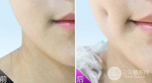 酒窩整形后的恢復(fù)時(shí)間