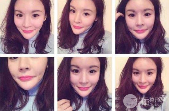 酒窩成形術(shù)的價(jià)格