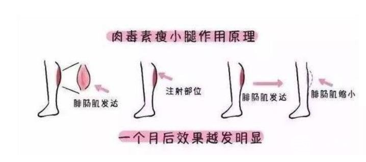 大腿肉注射瘦腿能打嗎？注射瘦腿的原理請(qǐng)重新審視一下！