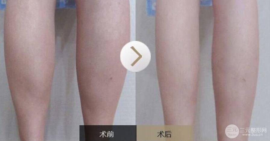 大腿肉注射瘦腿能打嗎？注射瘦腿的原理請(qǐng)重新審視一下！