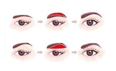 切眉術(shù)會(huì)留下疤痕嗎?