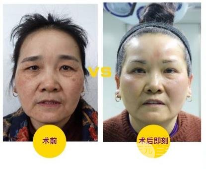 切眉術(shù)會(huì)留下疤痕嗎?