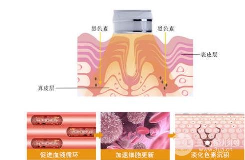 光子嫩膚哪家醫(yī)院好 謹(jǐn)記這幾點(diǎn)很重要~