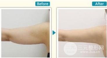 手臂抽脂多少錢？這個夏日甩掉蝴蝶臂吧~