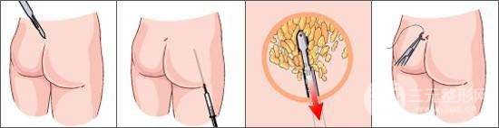 臀部吸脂手術(shù)