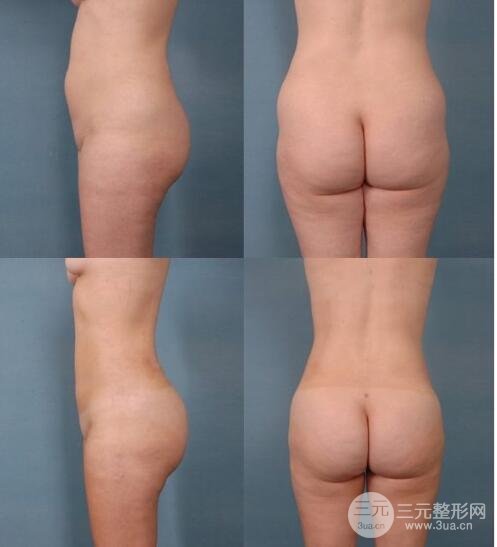 臀部吸脂手術(shù)果圖