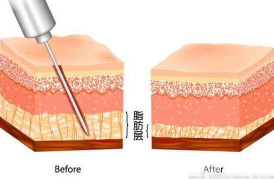 大腿吸脂手術(shù)介紹