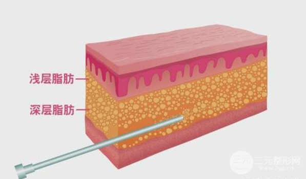 威塑抽脂有什么不同